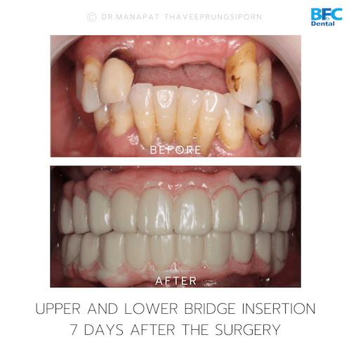 DENTAL ALL ON 4 case-6.1-1