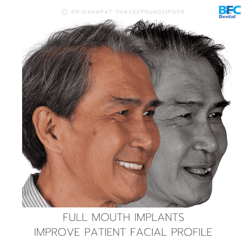 DENTAL ALL ON 4 case-7.2-1