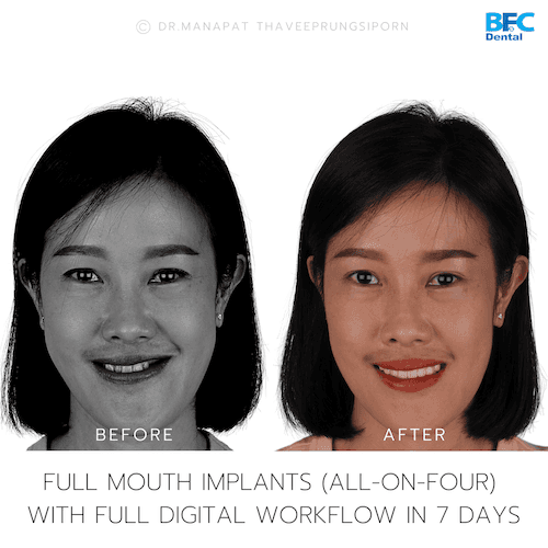 DENTAL ALL ON 4 case-8-1