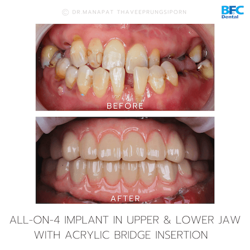 DENTAL ALL ON 4 case-8.1-1