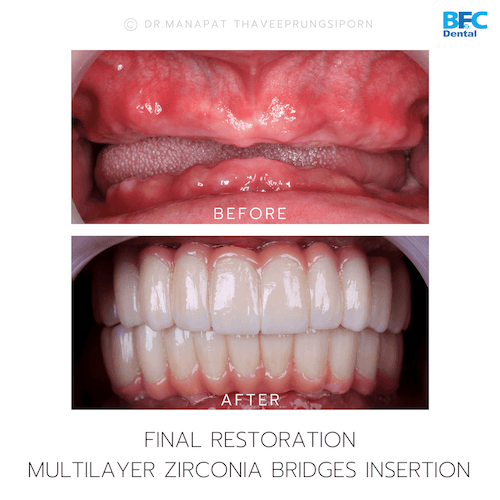 DENTAL ALL ON 4 case-9.1-1