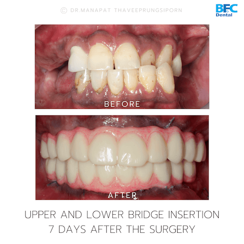 DENTAL ALL ON 4 case-12.1