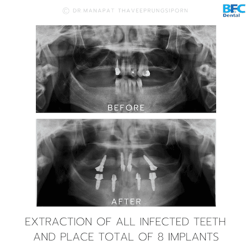 DENTAL ALL ON 4 case-12.2
