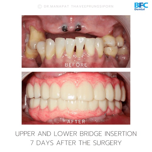 DENTAL ALL ON 4 case-13.1