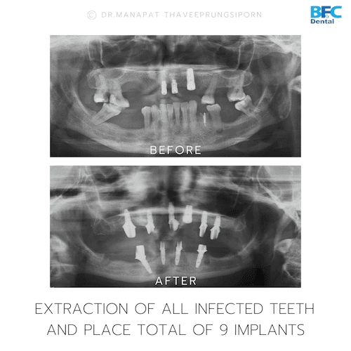 DENTAL ALL ON 4 case-13.2