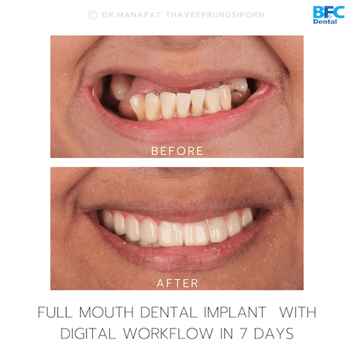 DENTAL ALL ON 4 case-13