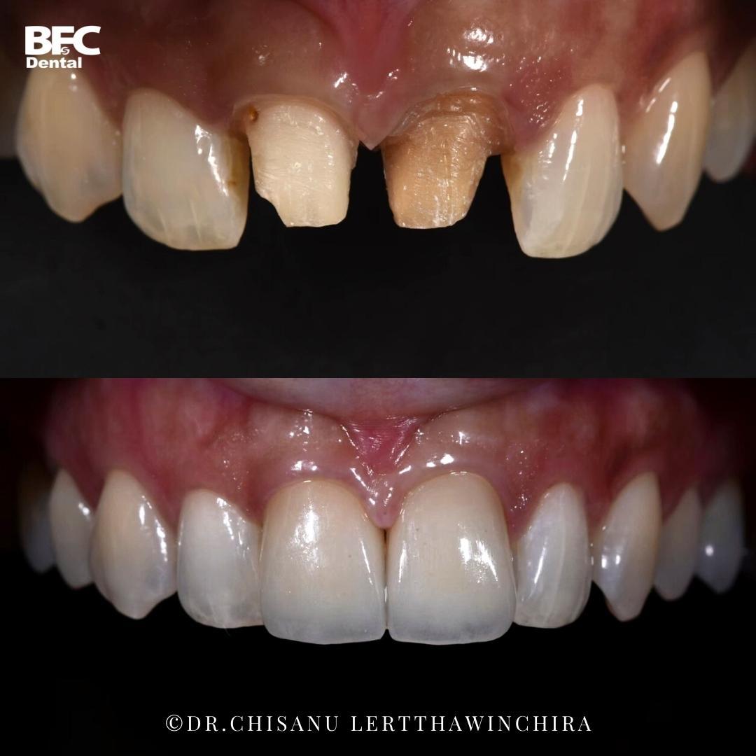 ceramic-veneers-3
