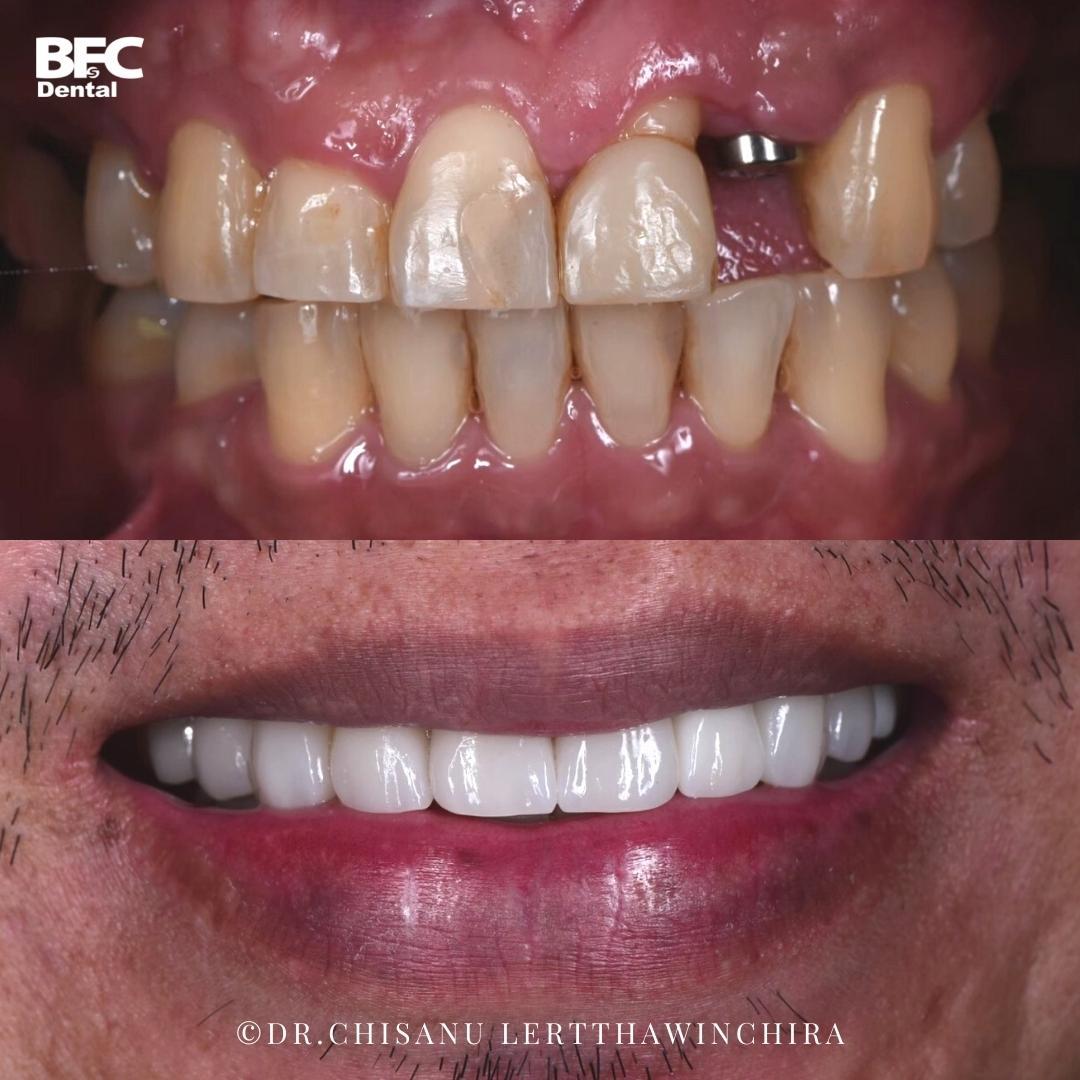 ceramic-veneers-crown-5