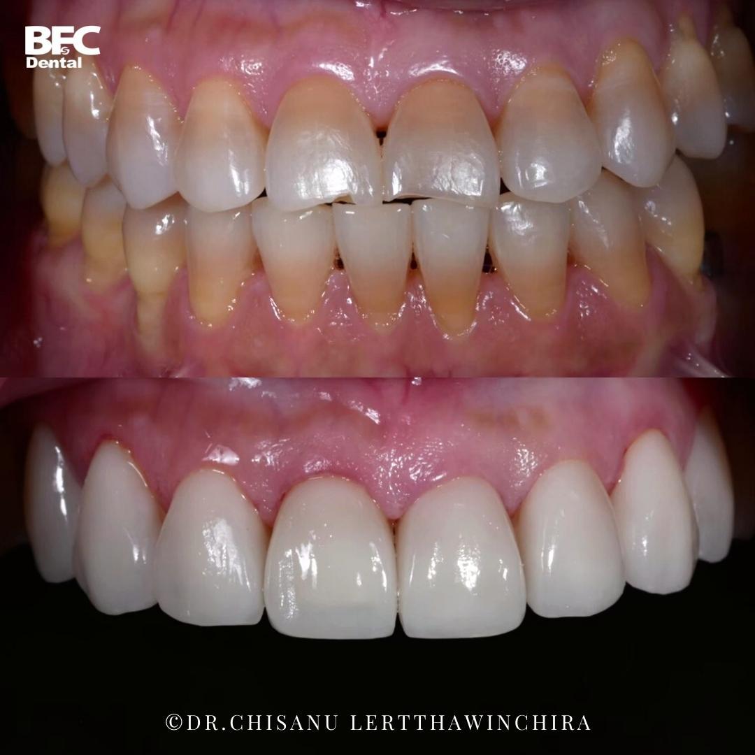 ceramic-veneers-6