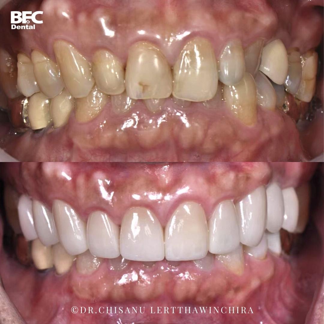 ceramic-veneers-9-clear-aligner