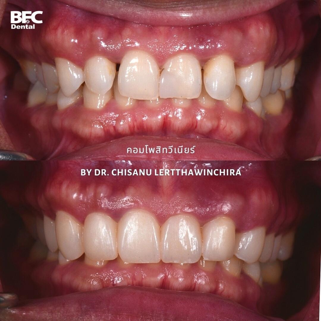 composite-veneers-1
