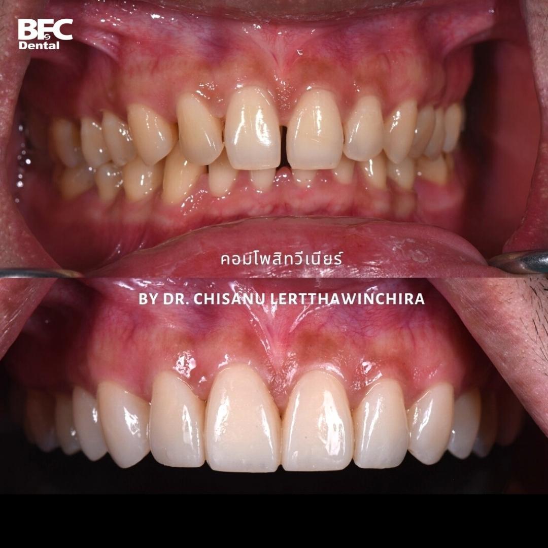 composite-veneers-2
