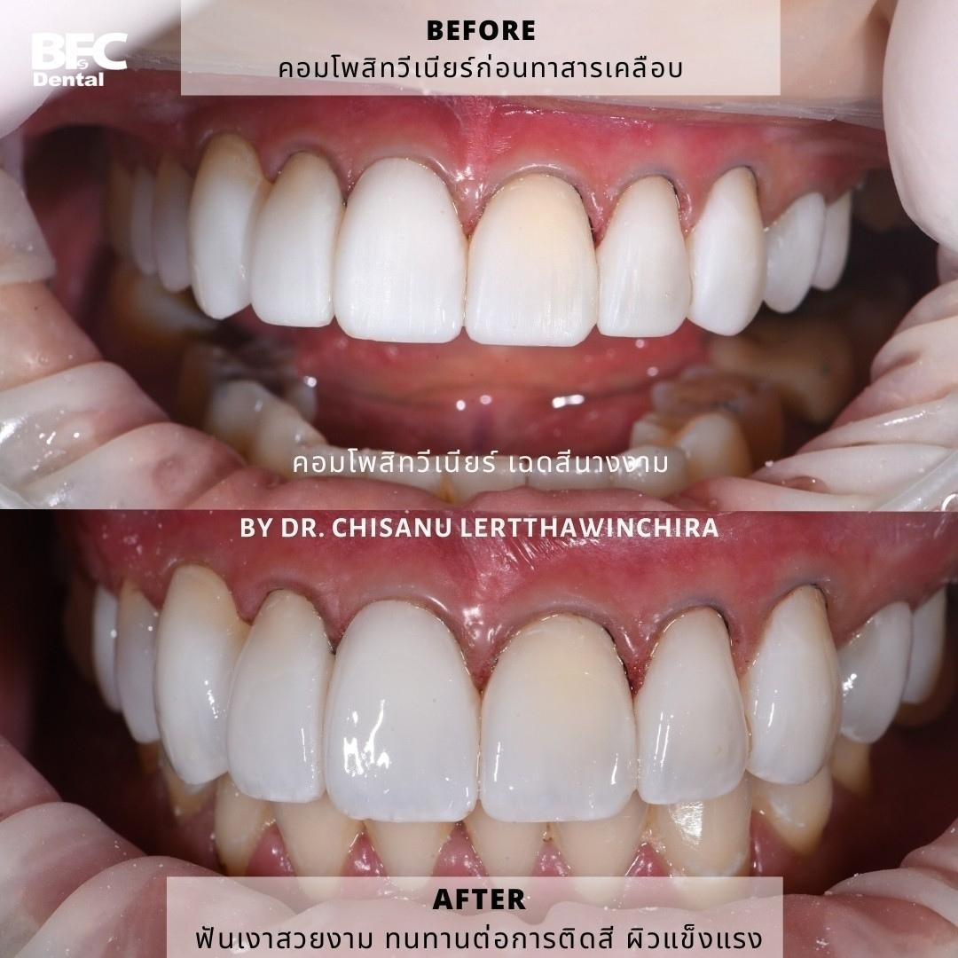 composite-veneers-4