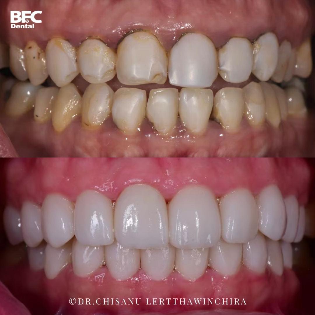 composite-veneers-10