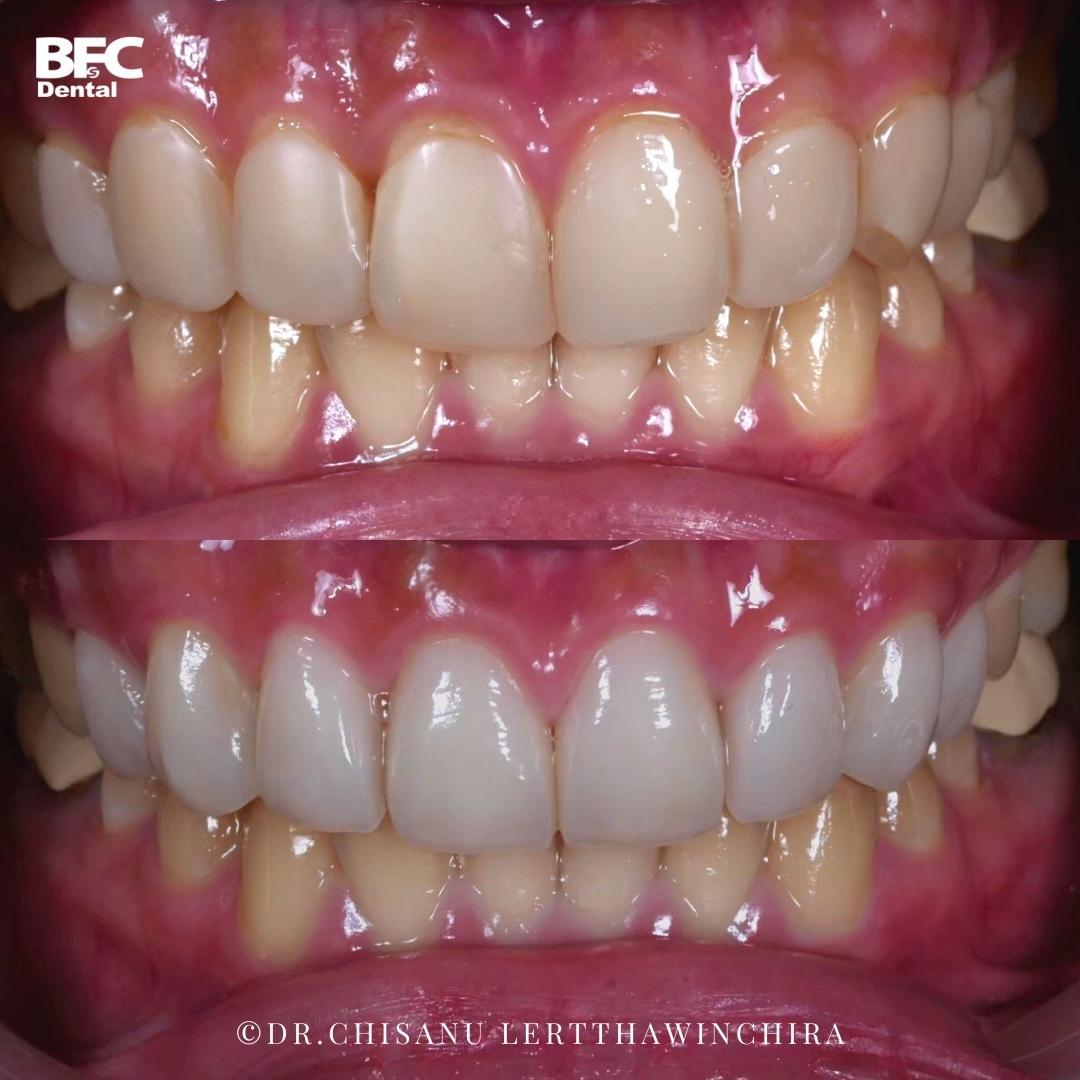 composite-veneers-11