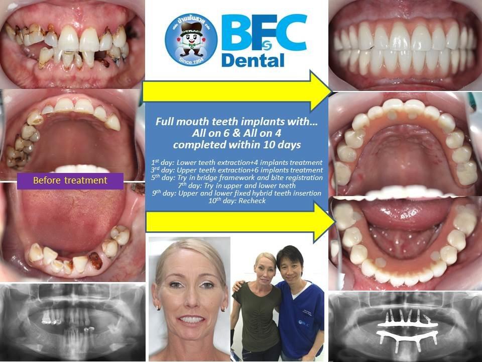 Dental all on 6 all on4 