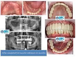 Global dental reconstruction 