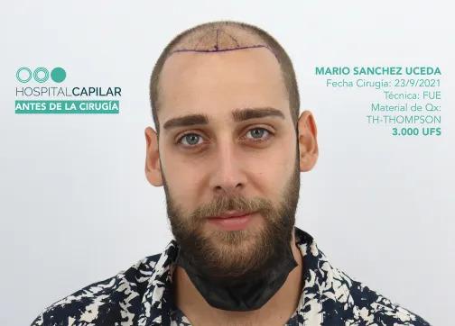 hospital capillar before hair transplant