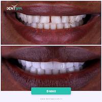DENTSPA ISTANBUL EMAX VENEERS16