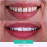 DENTSPA ISTANBUL EMAX VENEERS13