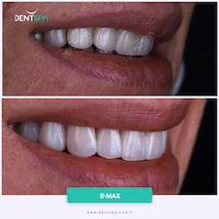 DENTSPA ISTANBUL EMAX VENEERS14