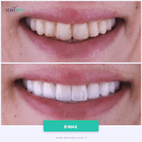 DENTSPA ISTANBUL EMAX VENEERS9