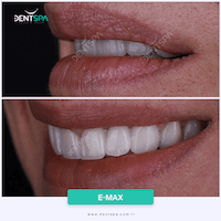 DENTSPA ISTANBUL EMAX VENEERS3