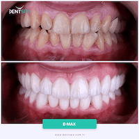 DENTSPA ISTANBUL EMAX VENEERS6