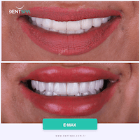 DENTSPA ISTANBUL EMAX VENEERS11