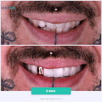 DENTSPA ISTANBUL EMAX VENEERS12
