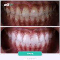DENTSPA ISTANBUL EMAX VENEERS15