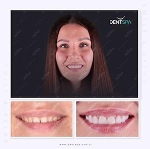 DENTSPA ISTANBUL EMAX VENEERS1