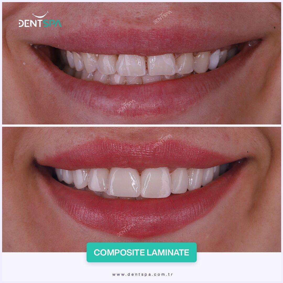 Dent Spa Composite venners