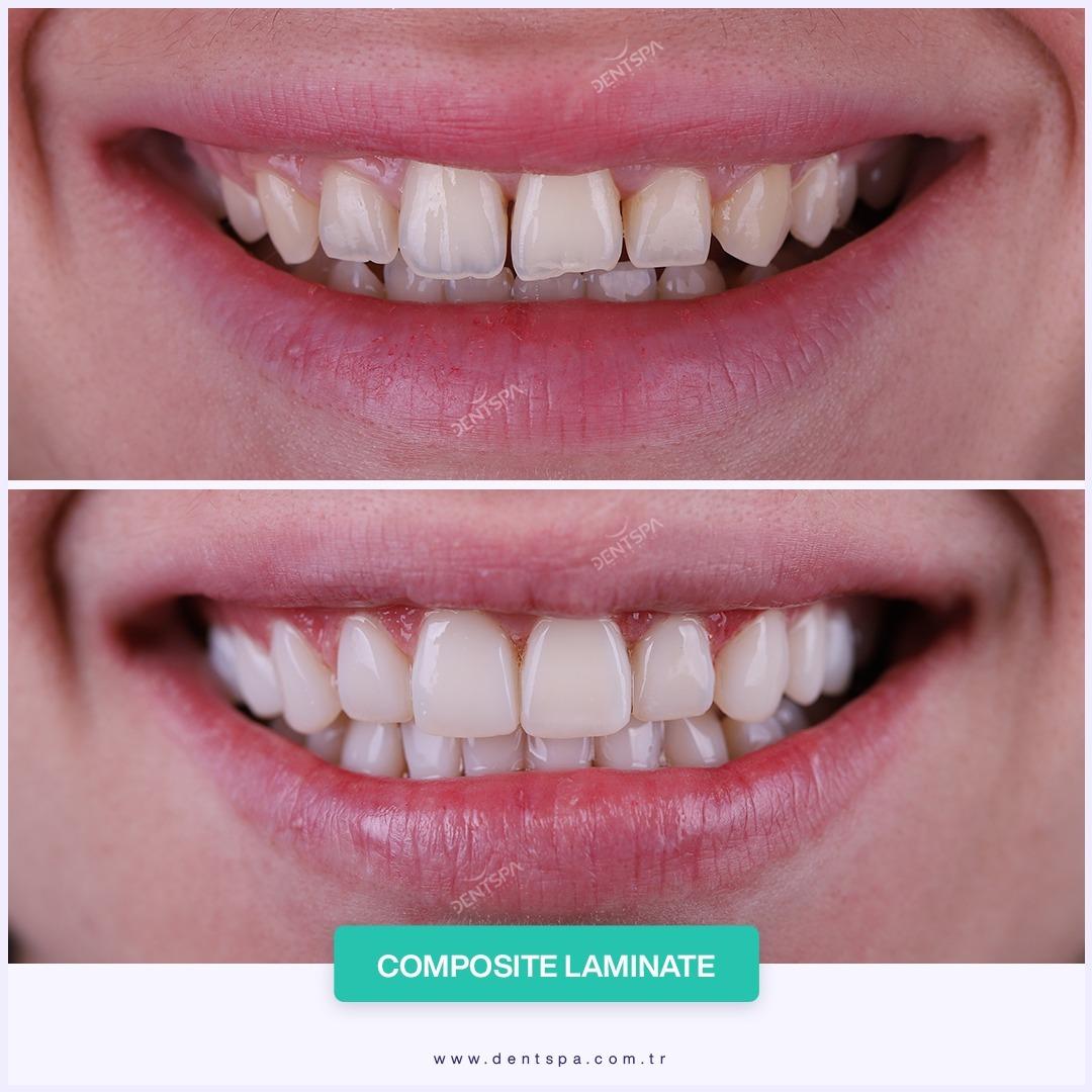 Dent Spa Composite venners