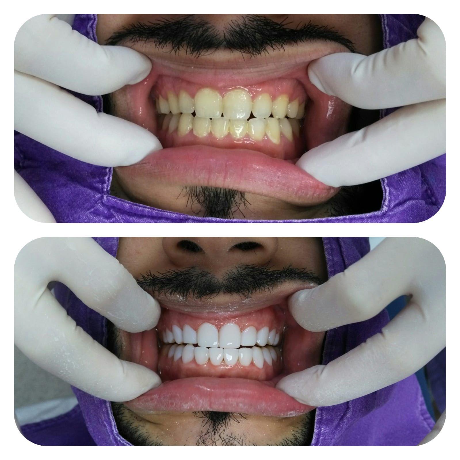 Dent Spa Composite venners