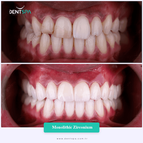 DENTSPA ISTANBUL ZIRCONIUM CROWNS 5