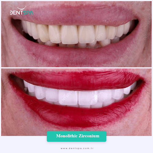 DENTSPA ISTANBUL ZIRCONIUM CROWNS 4