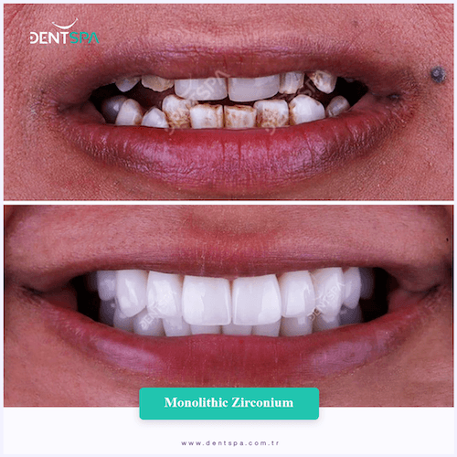 DENTSPA ISTANBUL ZIRCONIUM CROWNS 3