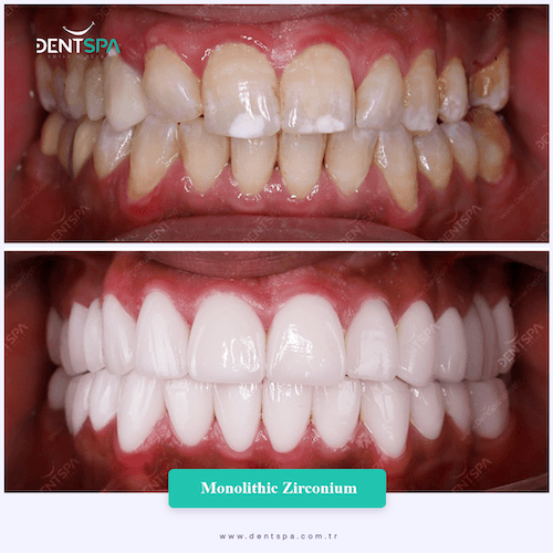 DENTSPA ISTANBUL ZIRCONIUM CROWNS 2