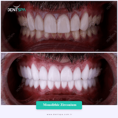 DENTSPA ISTANBUL ZIRCONIUM CROWNS 1