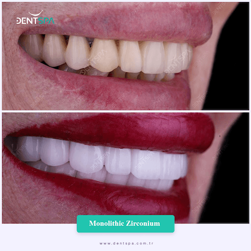 DENTSPA ISTANBUL ZIRCONIUM CROWNS 6