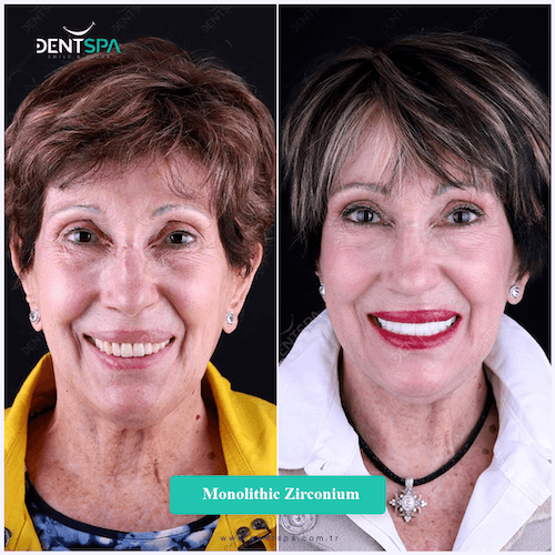 DENTSPA ISTANBUL ZIRCONIUM CROWNS 7