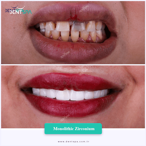 DENTSPA ISTANBUL ZIRCONIUM CROWNS 9