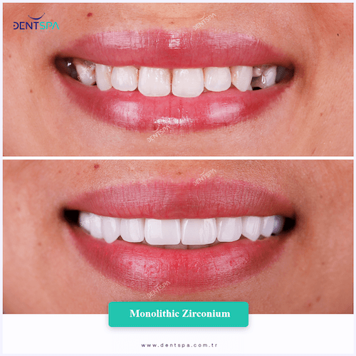 DENTSPA ISTANBUL ZIRCONIUM CROWNS 10