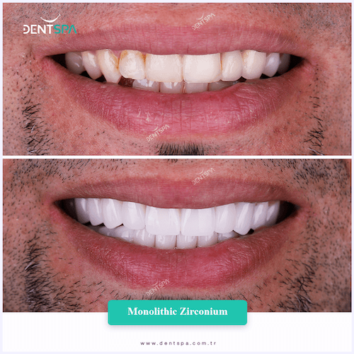 DENTSPA ISTANBUL ZIRCONIUM CROWNS 11