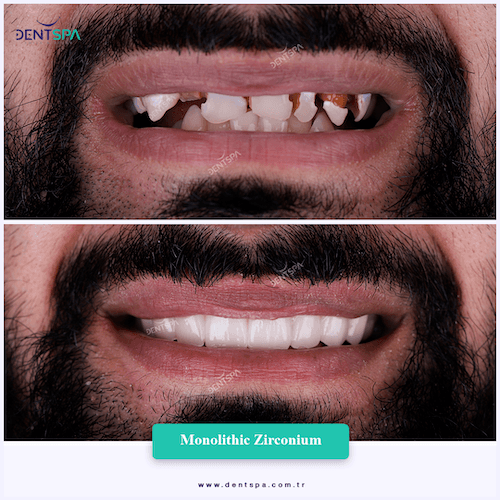 DENTSPA ISTANBUL ZIRCONIUM CROWNS 12