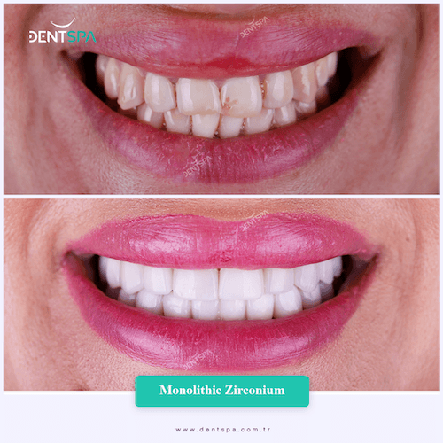 DENTSPA ISTANBUL ZIRCONIUM CROWNS 13