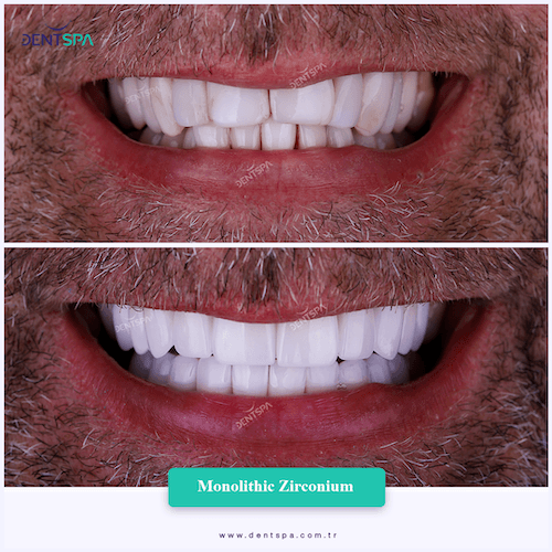 DENTSPA ISTANBUL ZIRCONIUM CROWNS 15