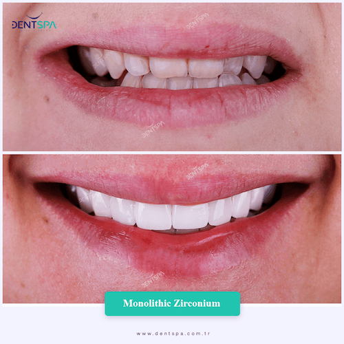 DENTSPA ISTANBUL ZIRCONIUM CROWNS 16