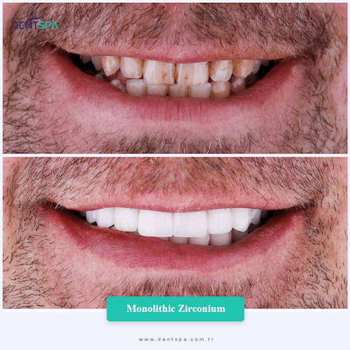 DENTSPA ISTANBUL ZIRCONIUM CROWNS 17